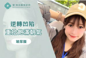 璧時尚台北醫美 蘋果肌填補與法令紋改善 療程前後對照