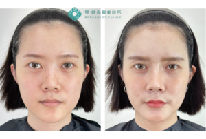 璧時尚台中醫美 全臉填補與蘋果肌輪廓精雕 療程前後對照