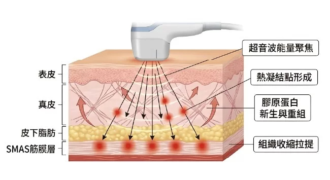 Acculiner-晶準極線超音波-5 璧˙時尚醫美診所_2026 緊緻拉提全攻略:鳳凰電波、美國音波、晶準極線音波差別在哪?醫師教你精準選對療程_線雕拉提_臉部拉提推薦_法令紋改善_輪廓線修飾_璧時尚診所_PDO線材_高雄醫美_台中醫美_台北醫美_醫美推薦