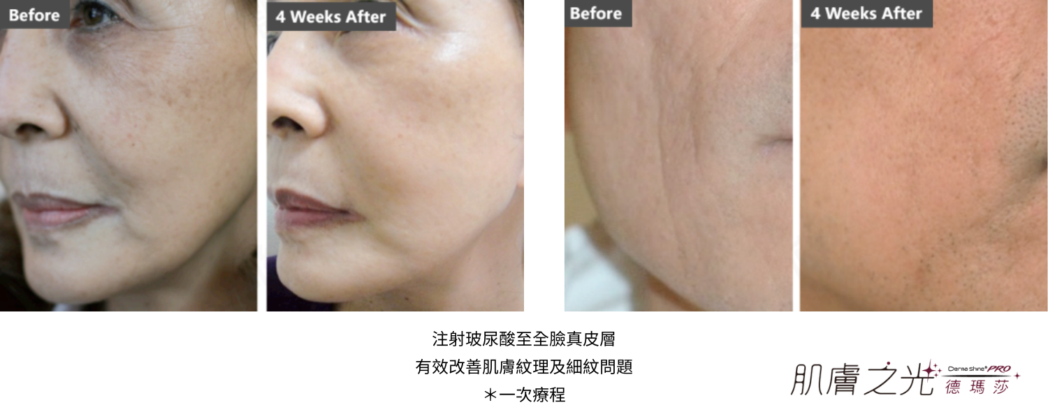 Derma Shine PRO 肌膚之光德瑪莎 (2) 璧˙時尚醫美診所_服務項目_蘋果肌-淚溝_法令紋_皺紋_立體唇珠-玻尿酸豐唇 _下顎線緊緻-下顎線_高雄醫美_玻尿酸培訓-海德密絲