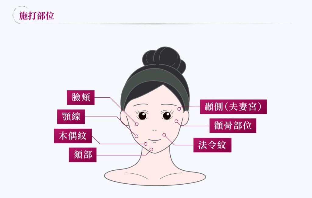 Sculptra 4D 舒顏萃 11 璧˙時尚醫美診所_舒顏萃_Sculptra_童妍針_醫美推薦_蘋果肌_聚左旋乳酸_PLLA_法令紋_臉頰凹陷_高雄醫美_台中醫美_台北醫美_醫美推薦