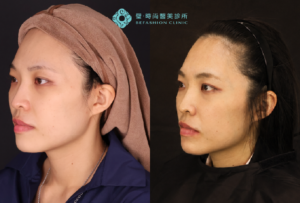 璧時尚高雄醫美 喬凡霓絲改善蘋果肌與法令紋 療程前後對照